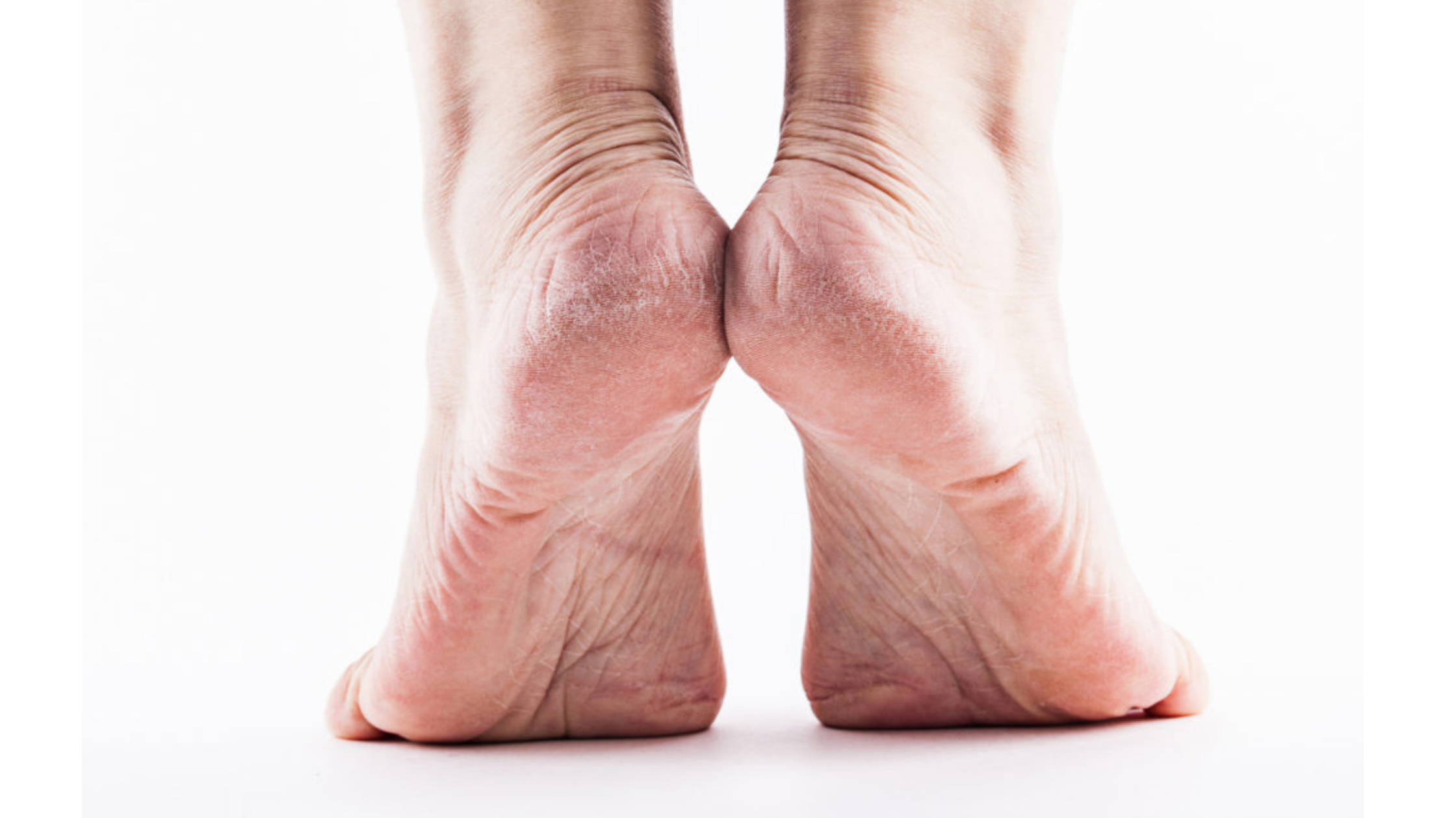 10 Ways to Dissolve (and Prevent) Dead Skin Buildup on Your Feet