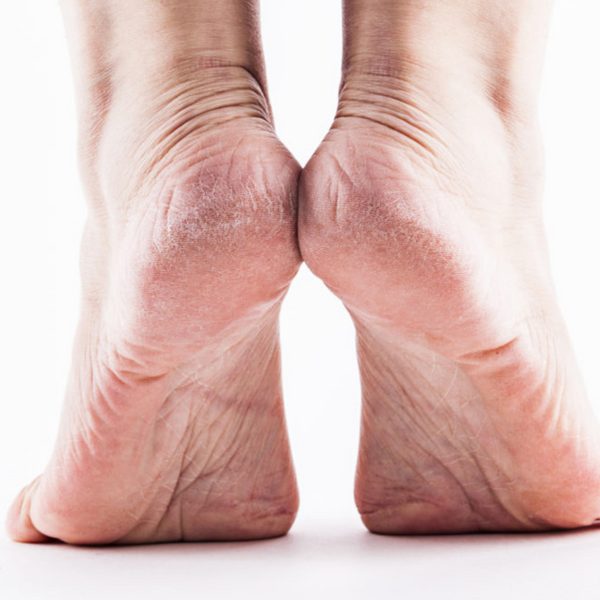 How do you remove dead skin from your feet?